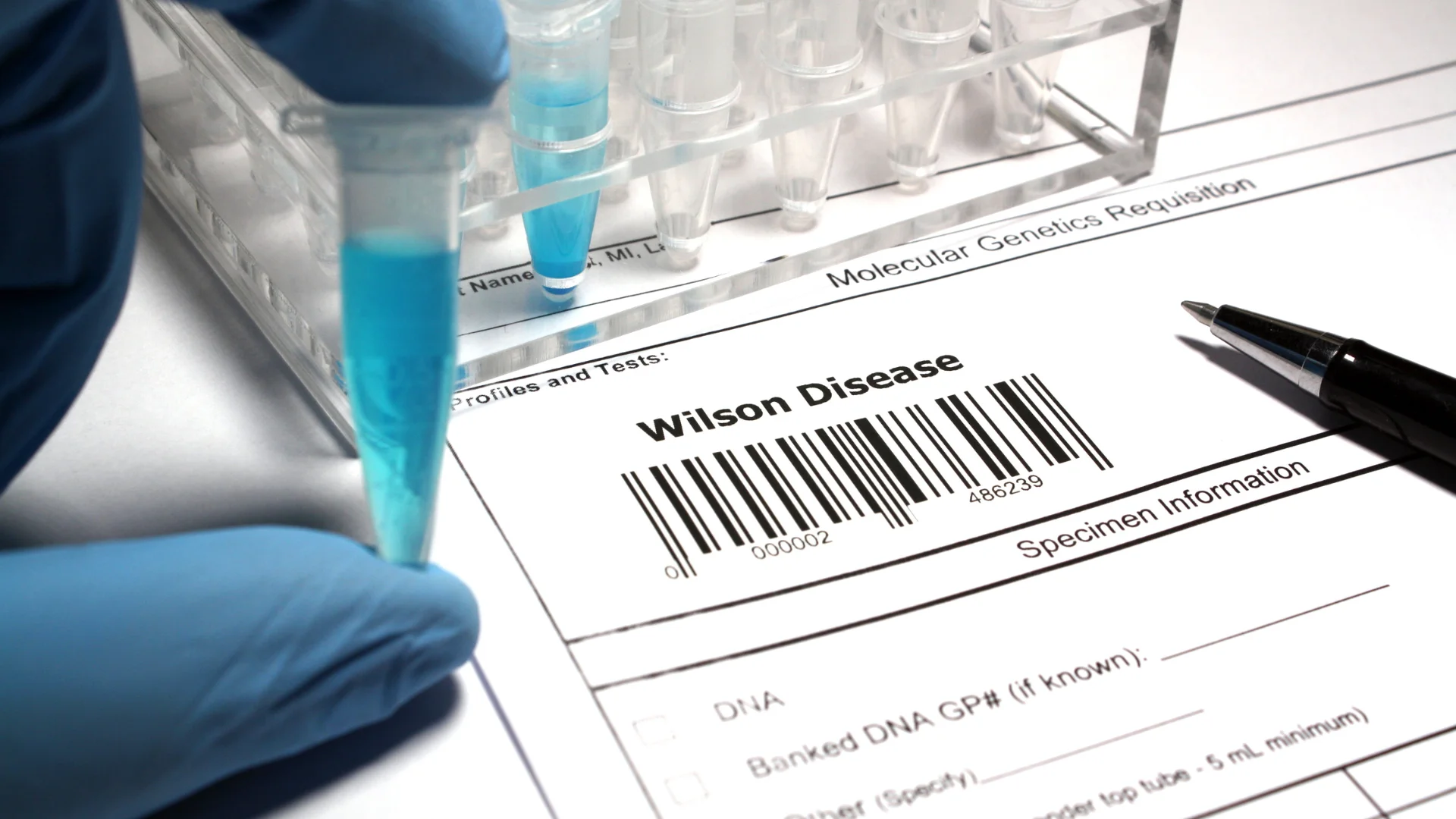 Wilson’s Disease